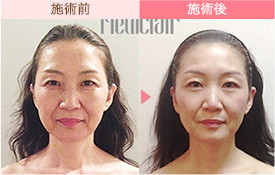 ビフォーアフター