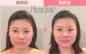 ビフォーアフター